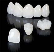 Kay dental Tucson Crowns and Bridges