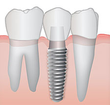Kay Dental Tucson Implants