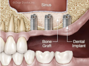 Kay Dental Tucson Implants