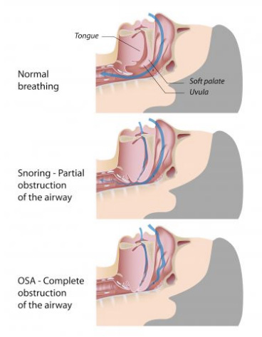 Sleep Apnea